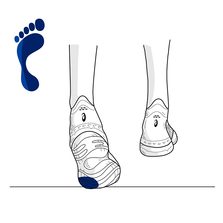 underPronation underPronation